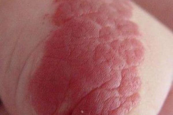 风水胎记胎记是红色的好吗危害