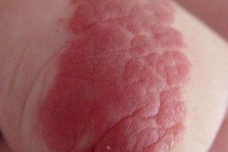 风水胎记胎记是红色的好吗危害