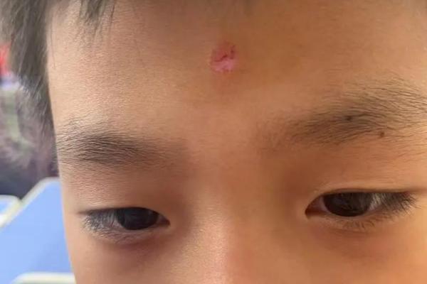 观音痣和美人痣的区别 观音痣是长在哪里