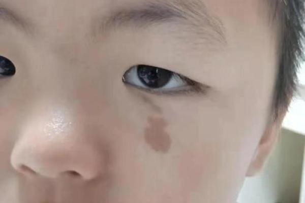 胎记算命大全