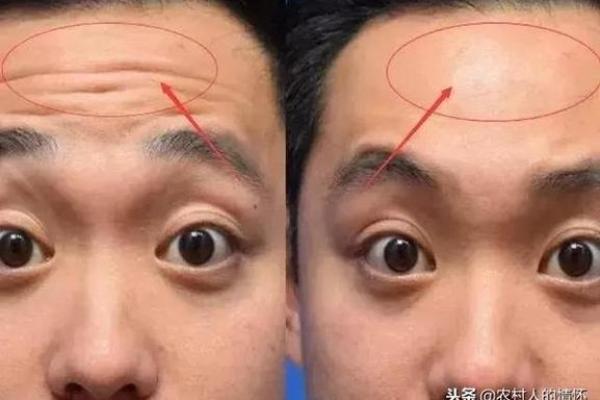 八字皱纹