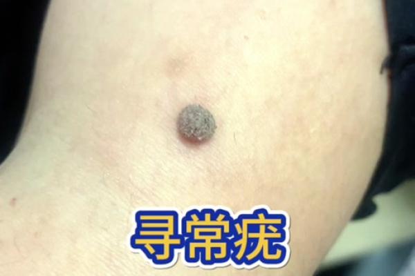 头上长瘊子好不好算命