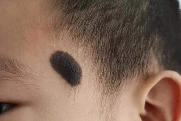 看胎记颜色类型算命