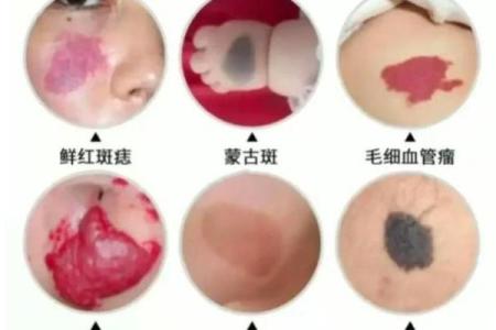 胎记算命图,后背胎记全面图解